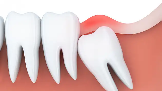 'Bütün gömülü dişlerin çekilmesi gerekmiyor'