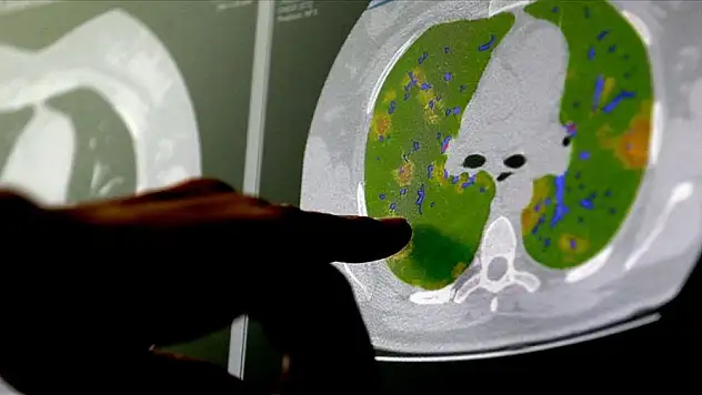 Kovid-19 virüsünün beyin hücreleriyle birleşebildiği kanıtlandı