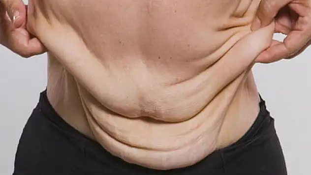 Tüp mide ameliyatı olanlar dikkat, uzmanı uyardı