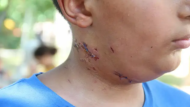 Köpek saldırısına uğrayan 10 yaşındaki çocuk ölümden döndü