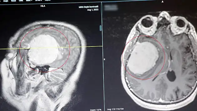Beyin tümörlerinde zaman kaybı ölüme yol açıyor