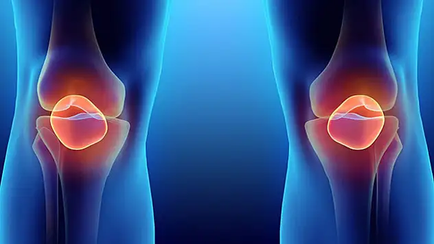 Diz kireçlenmesi tedavi altına alınabilir