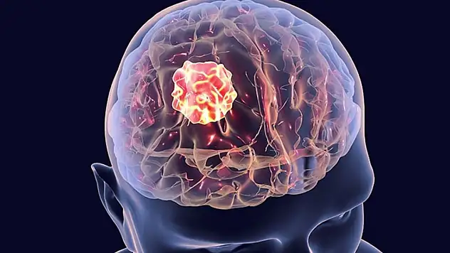 'İYİ HUYLU TÜMÖR'DE KÖTÜLEŞEBİLİR'