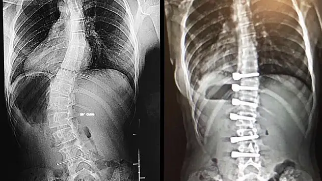 'Duruş bozukluğu skolyoz işareti olabilir'