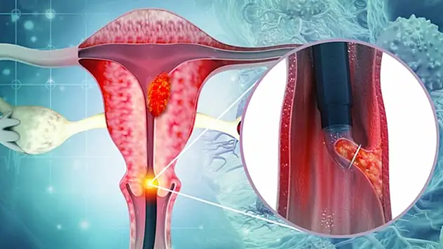 Kanser taraması hayat kurtarıyor