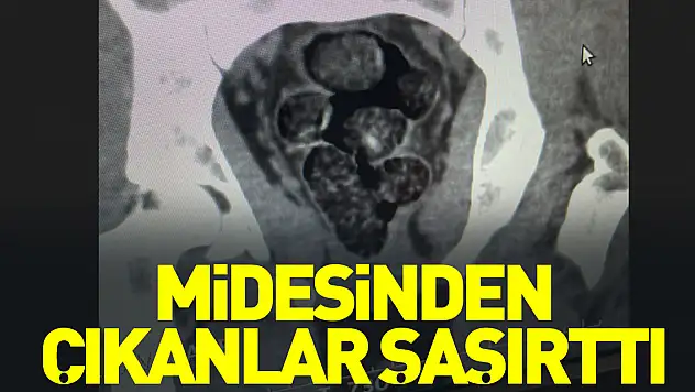 Midesinden çıkanlar şaşırttı