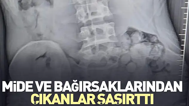 Mide ve bağırsaklarından çıkanlar şaşırttı