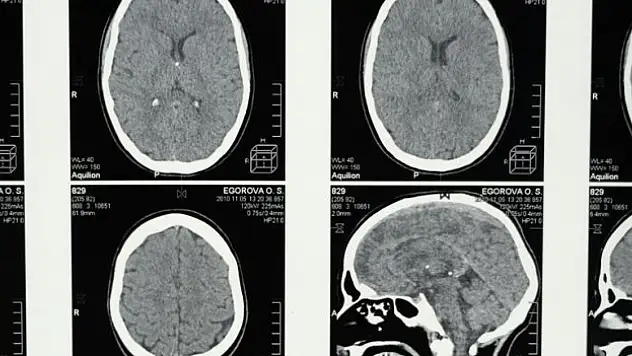 Alzheimer belirtisi olabilir