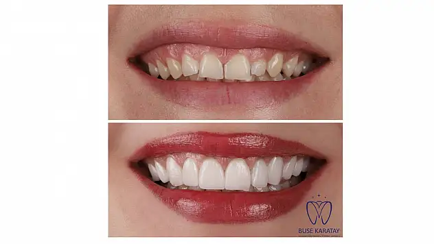 Estetik Bir Gülüş İçin Lamine Diş Çözüm mü?