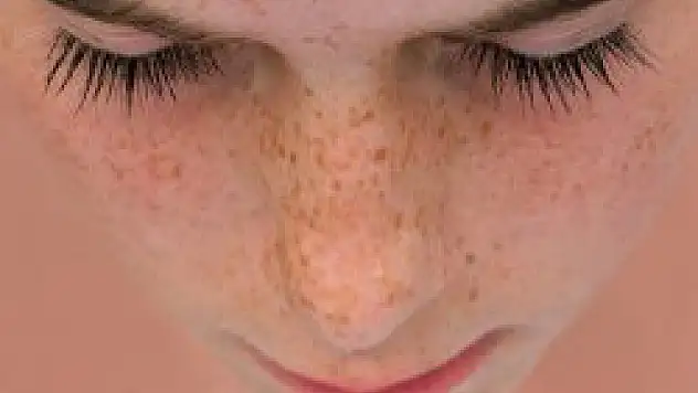 Güneş lekelerinden korunmanın yolları