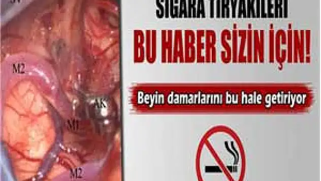 Sigara beyin damarlarını bu hale getiriyor