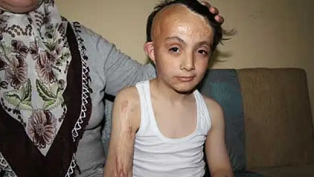 Üç yaşında yüzü yanan Mehdi'nin dramı