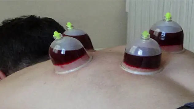 Saç dökülmesine hacamatlı çözüm