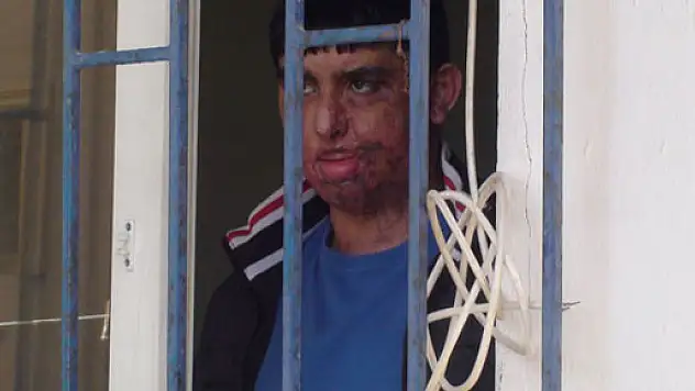 17 yaşındaki genç yüz nakli olmak için nakil bekliyor