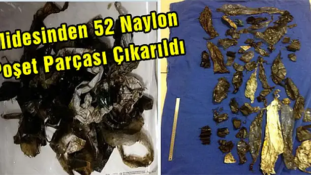  Midesinden 52 Naylon Poşet Parçası Çıkarıldı