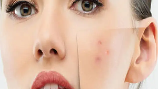 Akne ve sivilceye dikkat