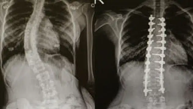 Omurga eğriliği olanlar OMÜ'de şifa buluyor