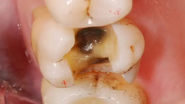 Çürük diş kalbe zarar veriyor