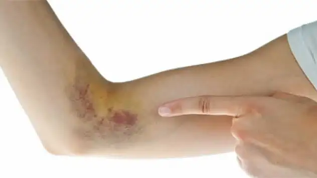 Ciltteki morarmaların nedenleri