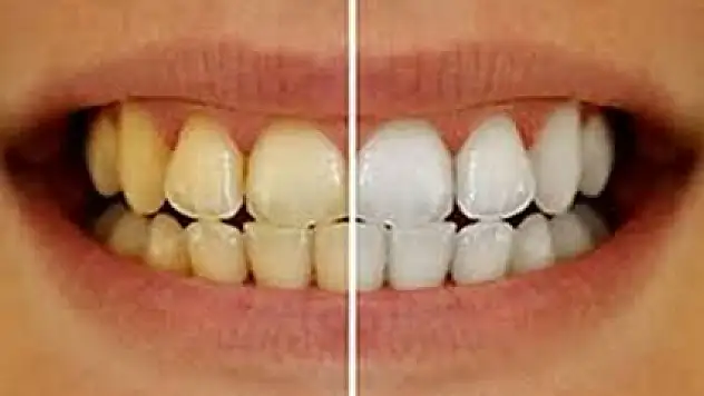 Dişlerdeki sararmayı ciddiye alın