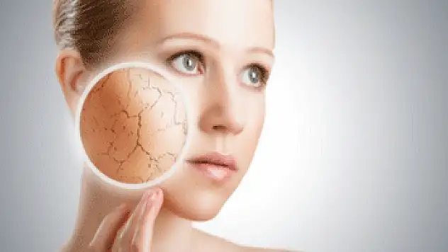 Kuru cilt probleminden kurtulmak mümkün