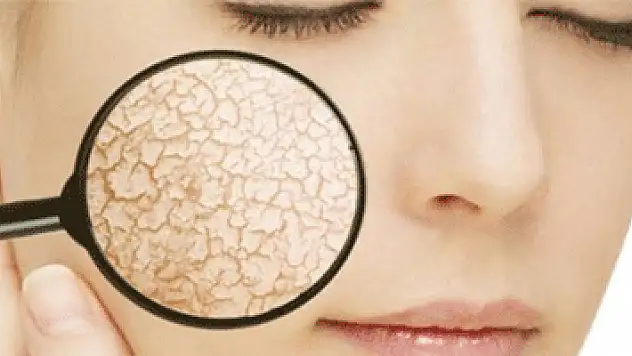 Kuruyan cildinizi hasta etmeyin