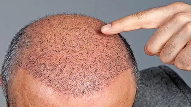 Saç ektiren kişilerde öz güven artıyor