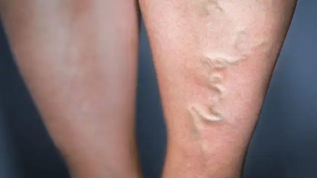 Ameliyatsız varis tedavisi mümkün'