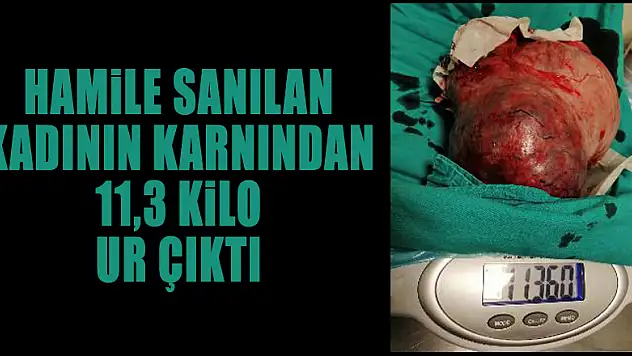 Hamile sanılan kadının karnından 11,3 kilo ur çıktı