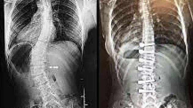 Uzmanından uyarı: 'Skolyoz tedavisi geciktirilmemeli'