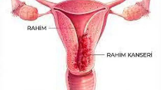 Rahim ağzı kanserinde erken teşhis hayat kurtarıyor