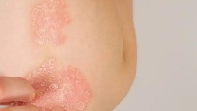 Prof. Dr. Özden'den sedef hastalarına müjde: 'Artık tedavisi var'