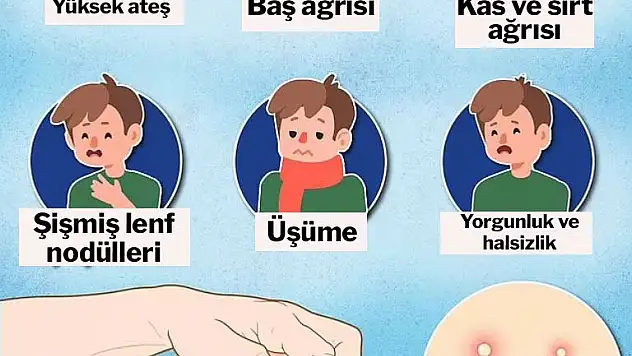 Maymun çiçeği salgınında korkutan uyarı: Semptomları değişiyor