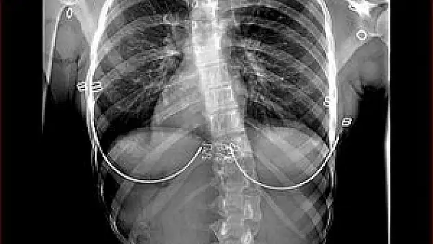 'Çocuklarda skolyoz tedavisi için en uygun zaman yaz tatili'