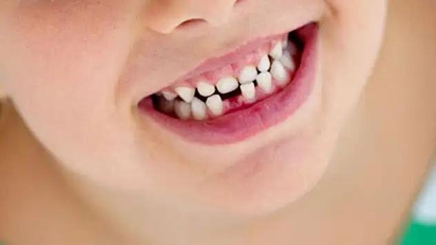 'Süt dişlerindeki kırılmaları pediatrik kaplamalarla önlemek mümkün'