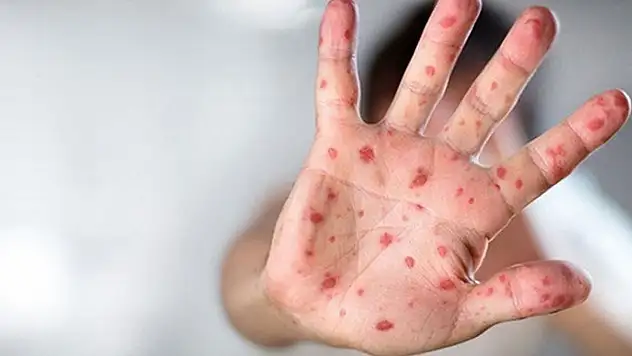 Uzmanı uyardı: Maymun çiçeği vakalarında artış bekleniyor