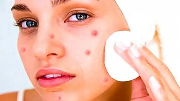 Doç. Dr. Pelin Üstüner, 'Skara dönüşen aknenin tedavisi yok'