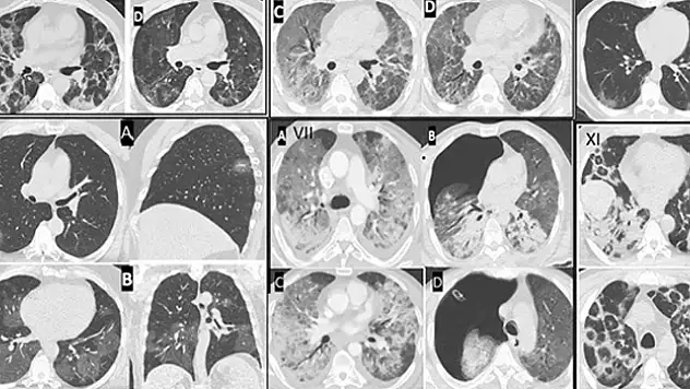 COVID salgının bıraktığı hasar, klinik araştırmalarla tespit ediliyor