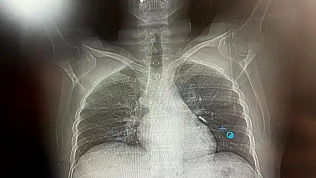 İmplant vidası ciğerine kaçan hasta ölümden döndü
