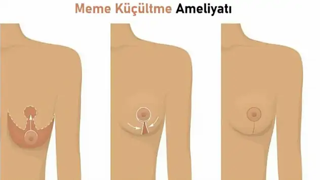 Meme Büyütme Ameliyatı: 2025 Rehberi