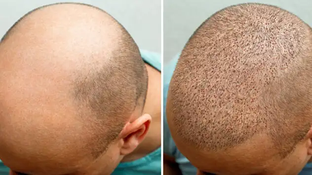 Saç Ekimi Fiyatlarını Etkileyen Faktörler: 2025 Rehberi