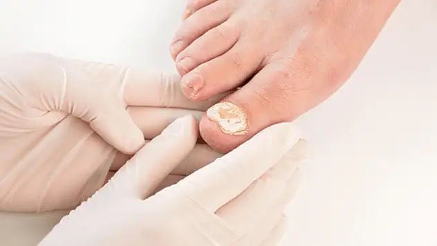 Tırnak Mantarı Tedavisi Farklı Yöntemlerle Uygulanabilir