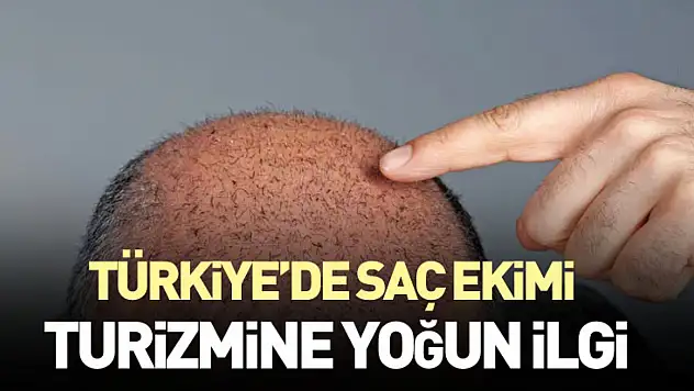 Türkiye'de Saç Ekimi Turizmine Yoğun İlgi