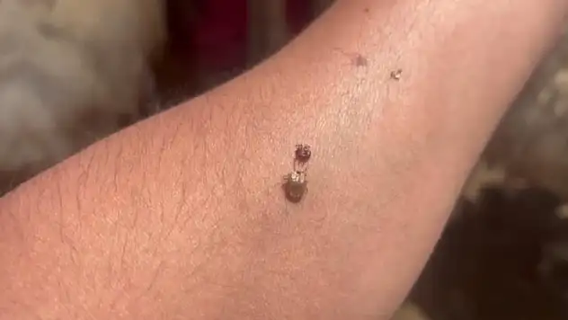 Uzmanlardan peş peşe uyarılar geliyor : Kene asla kendiniz tarafından çıkarılmamalı