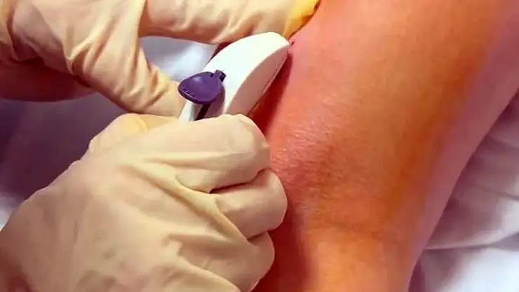 Deri altı implantı ile 3 yıl boyunca konforlu cinsel korunma