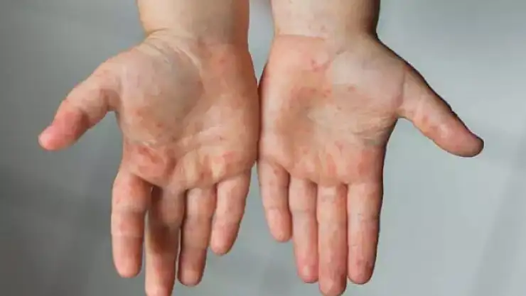 Çocuk sağlığı uzmanı uyardı: 'Kızamık aşı ile önlenebilen ciddi bir hastalık'