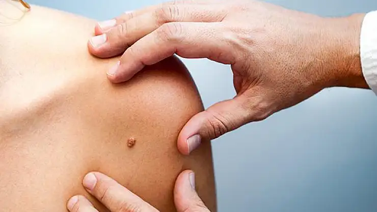 Uz. Dr. Işık cilt kanseri uyarısı yaptı