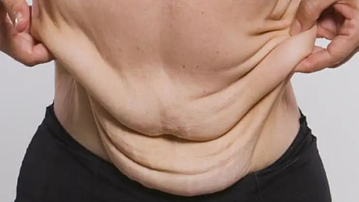 Tüp mide ameliyatı olanlar dikkat, uzmanı uyardı