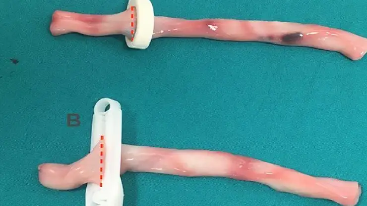 Yeni tasarım göbek kordonu klempi 'Faydalı Model' olarak tescillendi