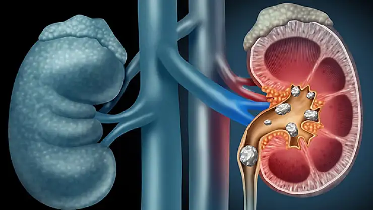 Böbrek taşı tanı ve tedavisinde lazer yöntemi